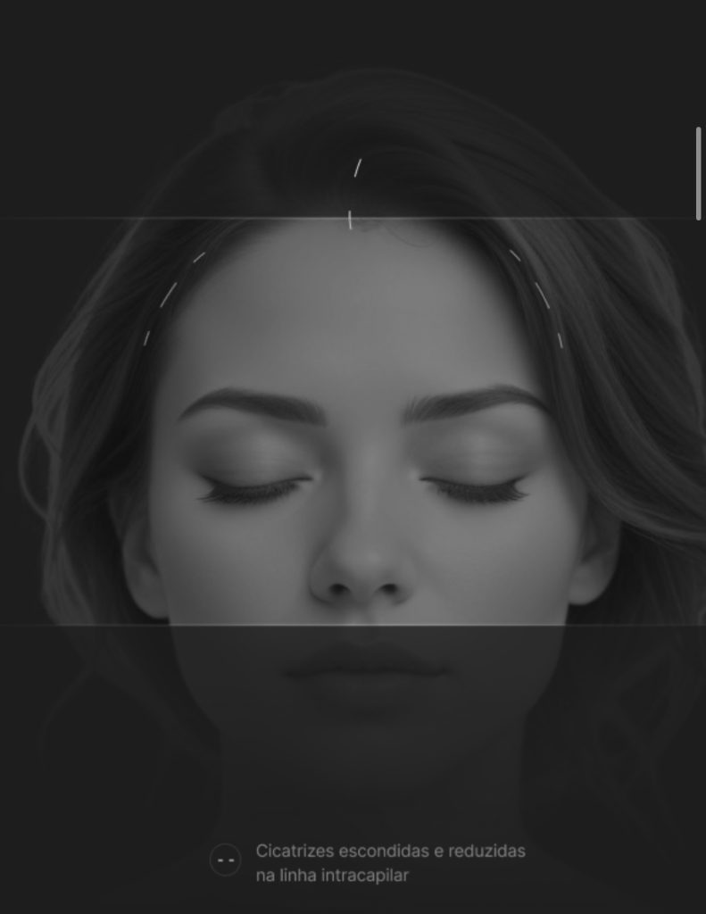 Endomidface Lift